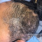 Pyure Natural Wellness eZy-Watermark_01-09-2020_02-34-41PM-150x150 Scalp Micropigmentation (SMP)  Gallery  