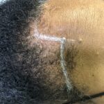 Pyure Natural Wellness IMG_0467-150x150 Scalp Micropigmentation (SMP)  Gallery  