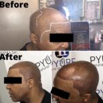 Pyure Natural Wellness IMG_0712-150x150 Scalp Micropigmentation (SMP)  Gallery  