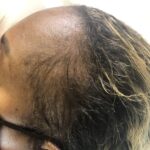 Pyure Natural Wellness IMG_0791-150x150 Scalp Micropigmentation (SMP)  Gallery  