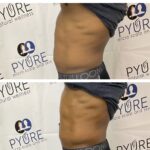 Pyure Natural Wellness IMG_1362-150x150 Body Contouring Gallery  