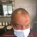 Pyure Natural Wellness IMG_9269-150x150 Scalp Micropigmentation (SMP)  Gallery  