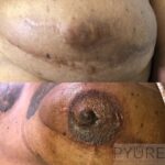 Pyure Natural Wellness eZy-Watermark_27-05-2021_11-07-50AM-150x150 Areola Repigmentation  